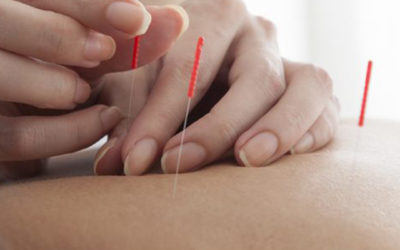 What is Acupuncture, How it Works and How it Can Help Your Pain